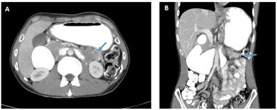 Concomitant Kinase-Dead BRAF and Oncogenic KRAS Lead to an Aggressive Biologic Behavior and Tumor Lysis Syndrome: A Case Report